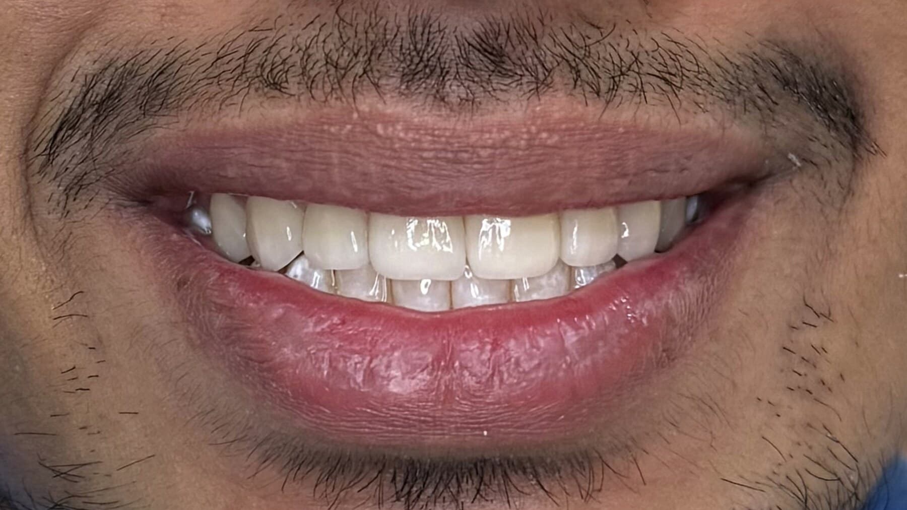 Smile Correction with Veneers — before treatment