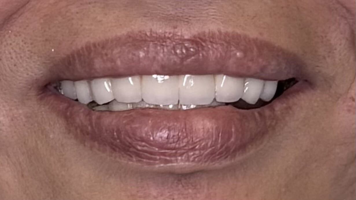 Full Mouth Rehabilitation — before treatment