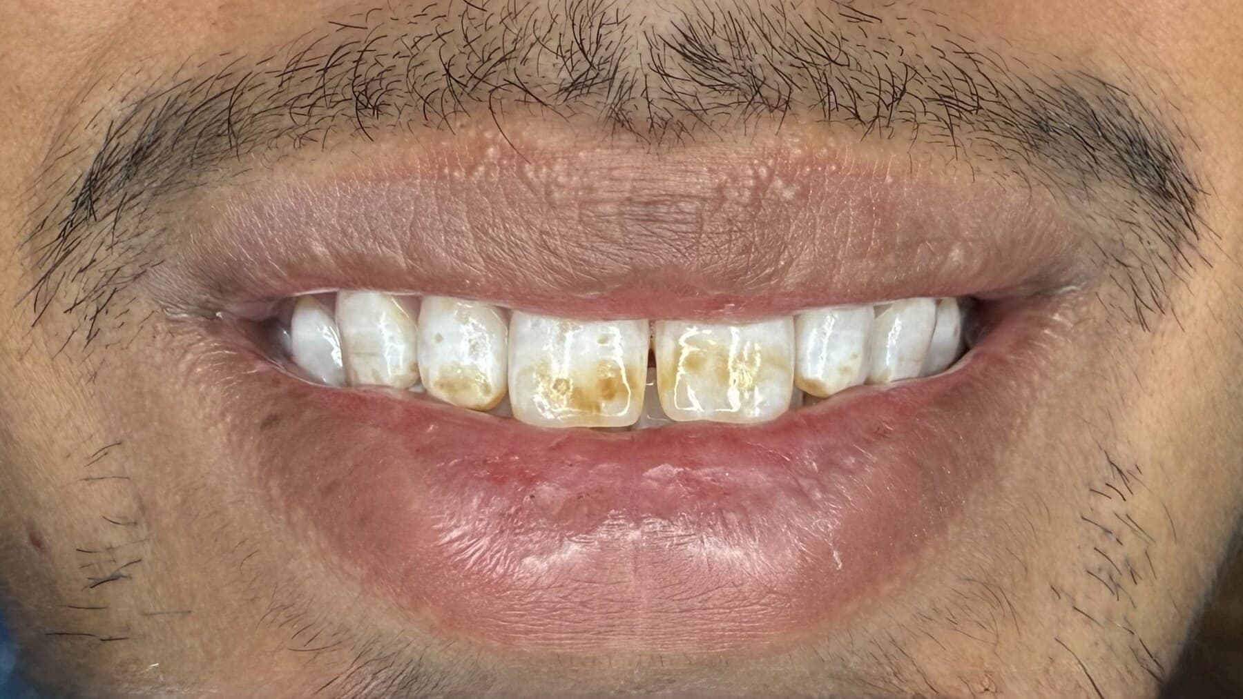 Smile Correction with Veneers — after treatment
