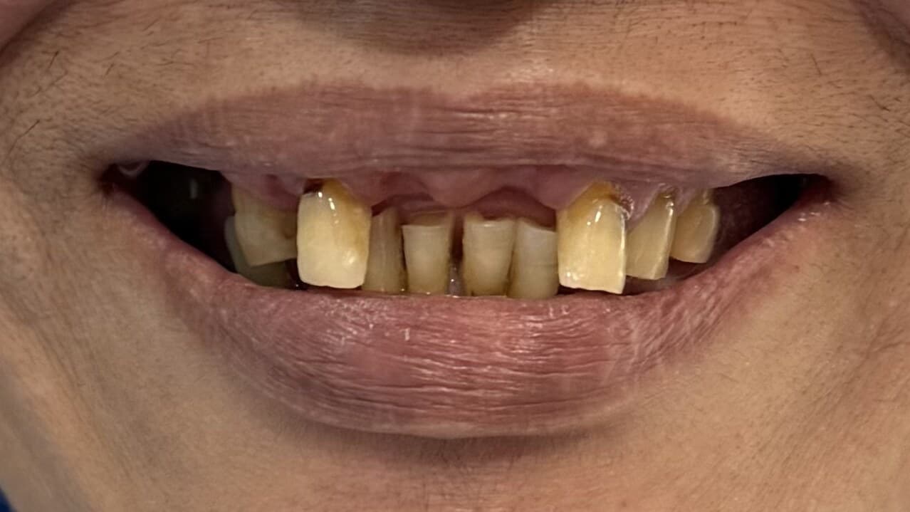Full Mouth Rehabilitation — after treatment