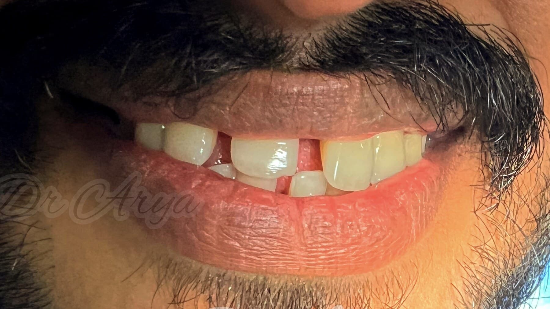 Smile Correction with Crown — after treatment